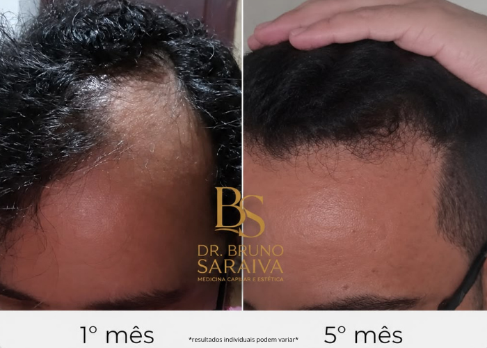 alopecia androgenética