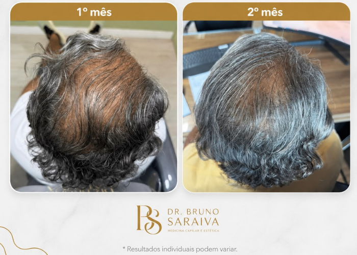 alopecia androgenética