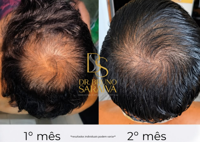 alopecia androgenética