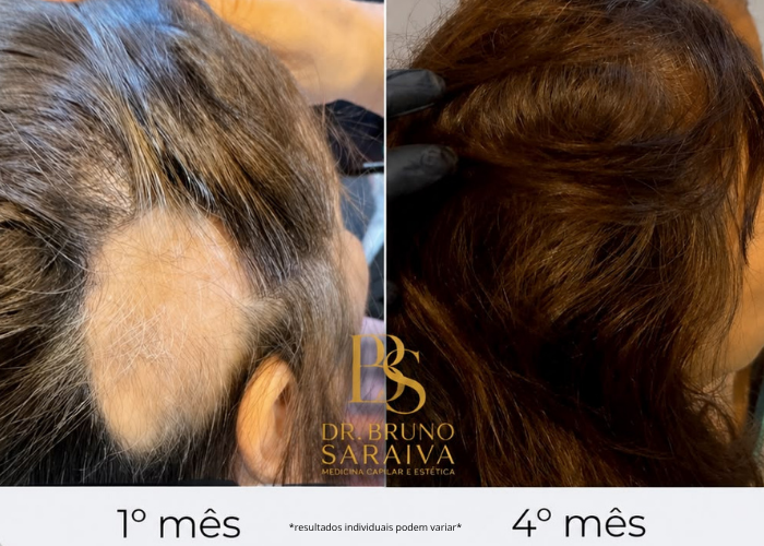 alopecia areata