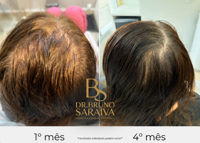 alopecia padrão feminino