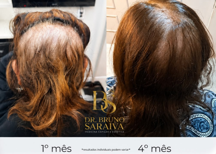 alopecia padrão feminino