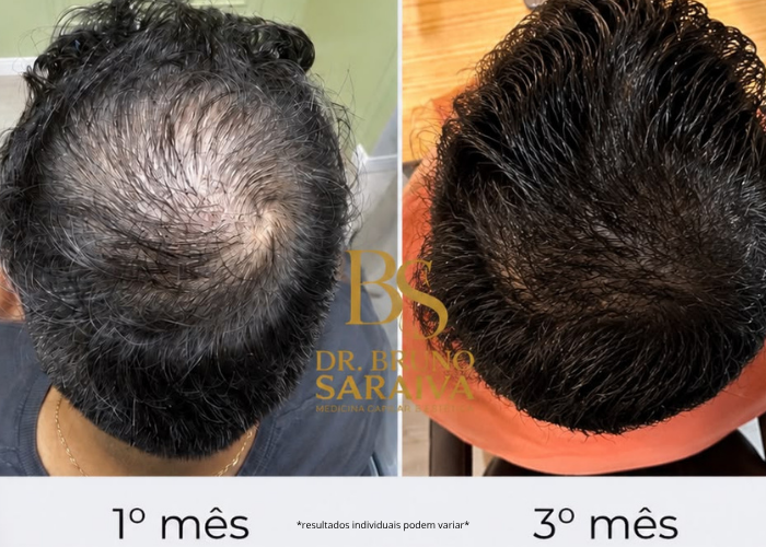 alopecia androgenética
