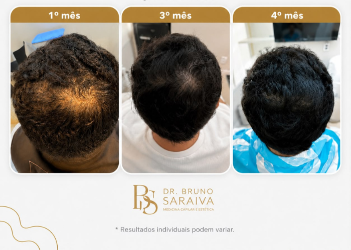 alopecia androgenética