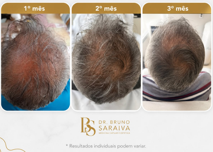 alopecia androgenética